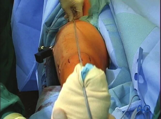 Retrograde Intramedullary Nailing for Periprosthetic Femoral Fractures After TKA: AO Standardized Surgical Strategy – Illustrated Step-by-Step Guide