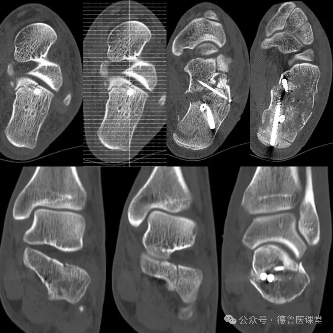 How to Perform a Successful Minimally Invasive Calcaneal Surgery