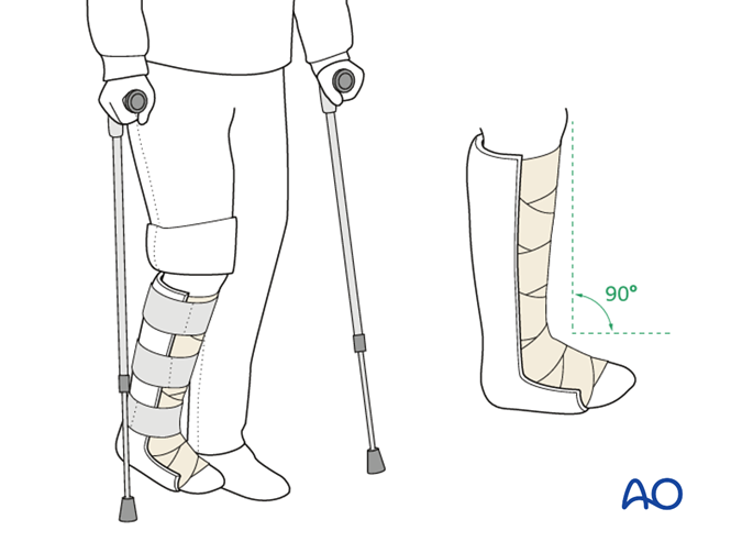 Minimally Invasive K‑Wire and Screw Fixation for Calcaneal Fractures