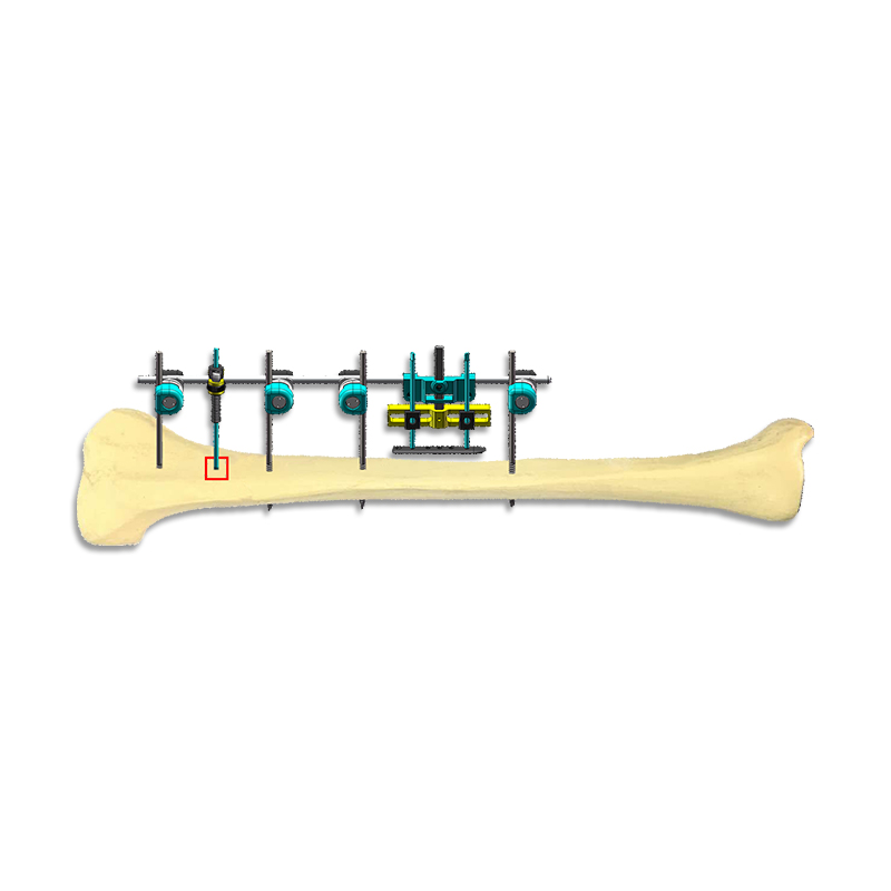 Horizontal Bone Transporter+Periosteal Traction Combined System