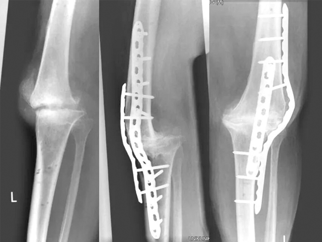Locking Compression Plate (LCP): Principles and Clinical Applications