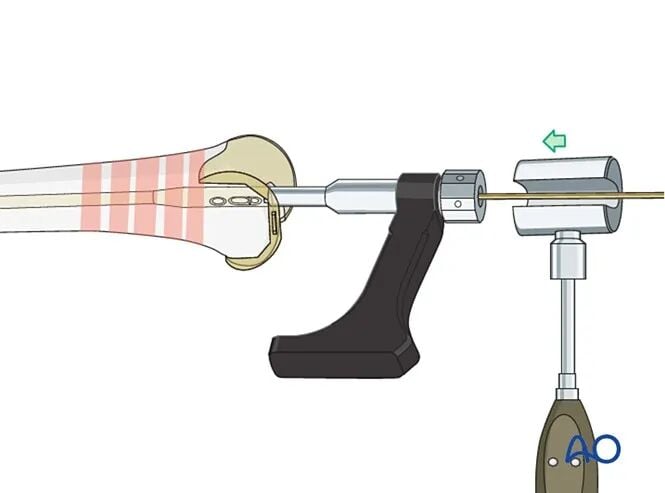 Retrograde Intramedullary Nailing for Periprosthetic Femoral Fractures After TKA: AO Standardized Surgical Strategy – Illustrated Step-by-Step Guide