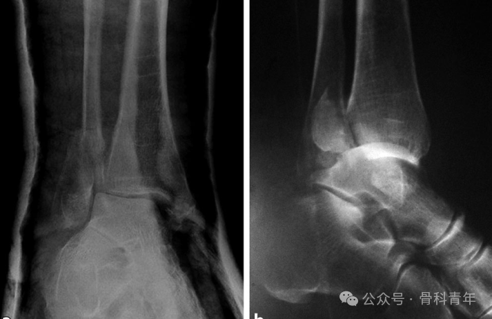 Surgical Steps
