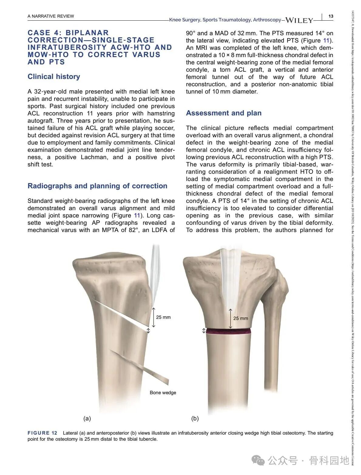 Technical Tips and Tricks for Complex Biplanar High Tibial Osteotomy