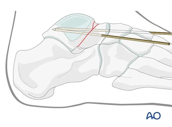 AO Standard Surgery: Screw Fixation for Displaced Talar Neck Fractures