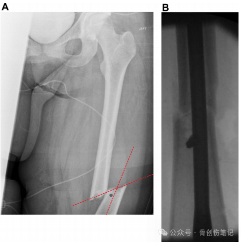 How to Precisely Place Poller (Blocking) Screws?