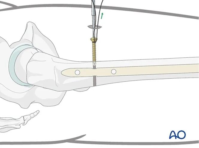 Retrograde Intramedullary Nailing for Periprosthetic Femoral Fractures After TKA: AO Standardized Surgical Strategy – Illustrated Step-by-Step Guide
