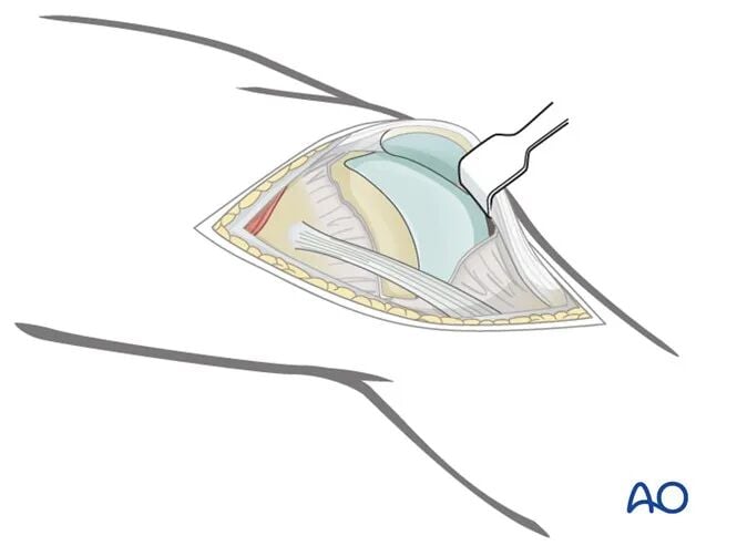 Minimally Invasive Lateral/Anterolateral MIPO Approach to the Distal Femur