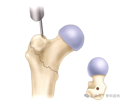 Changes in Entry Point for Intramedullary Nailing of Proximal Femoral Fractures: The Central Collinear Method