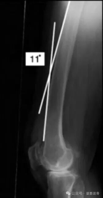 Clinical Decision-Making Between Long and Short Intramedullary Nails for Intertrochanteric Femoral Fractures