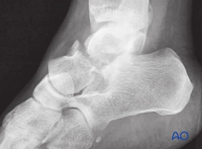 AO Standard Surgery: Screw Fixation for Displaced Talar Neck Fractures