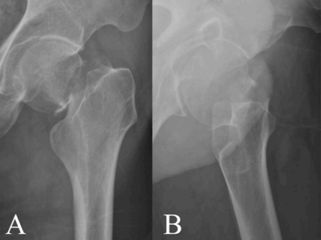 Femoral Neck Fracture Fixation Techniques: Latest Research Advances—A Narrative Review