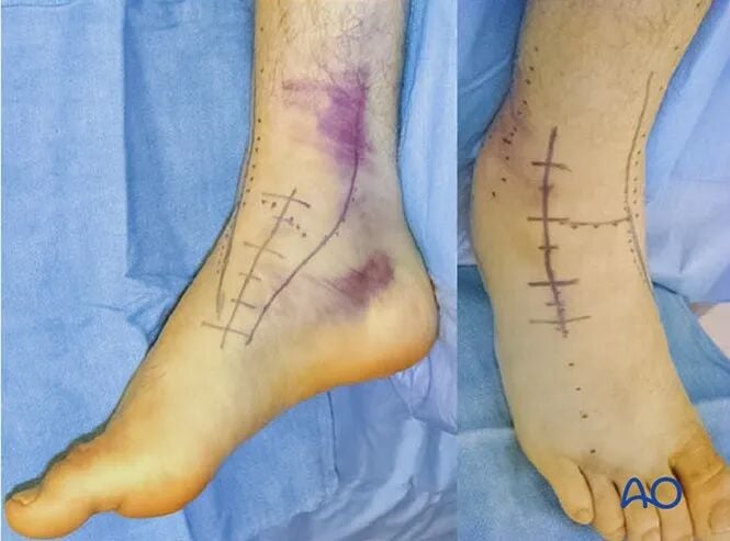 AO Standard Surgery: Screw Fixation for Displaced Talar Neck Fractures