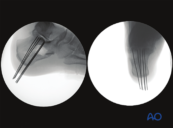 Minimally Invasive K‑Wire and Screw Fixation for Calcaneal Fractures