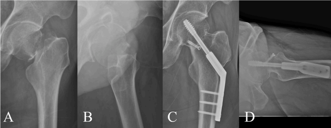 Femoral Neck Fracture Fixation Techniques: Latest Research Advances—A Narrative Review