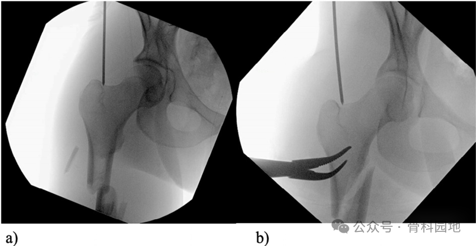Changes in Entry Point for Intramedullary Nailing of Proximal Femoral Fractures: The Central Collinear Method