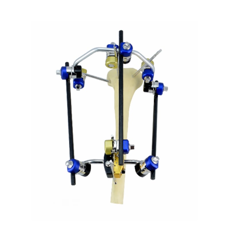 Proximal Tibia Standard Configuration of Combined External Fixator