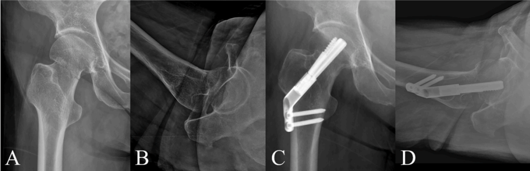 Femoral Neck Fracture Fixation Techniques: Latest Research Advances—A Narrative Review