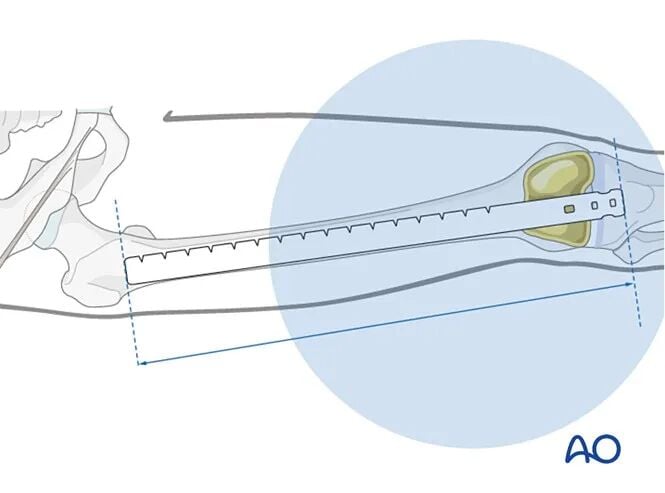 Retrograde Intramedullary Nailing for Periprosthetic Femoral Fractures After TKA: AO Standardized Surgical Strategy – Illustrated Step-by-Step Guide