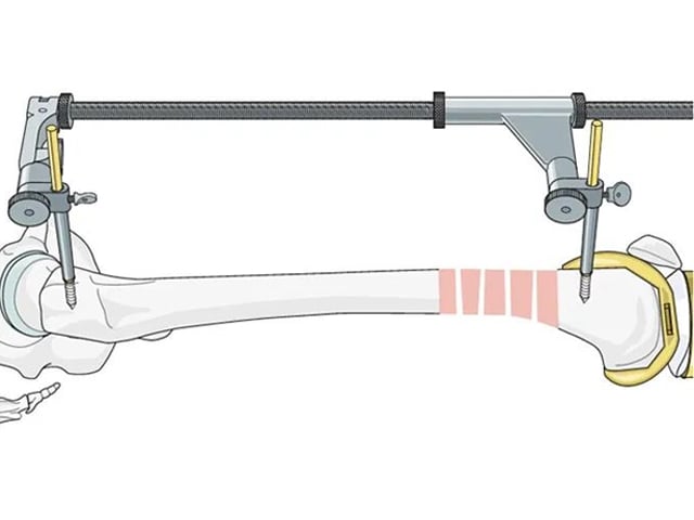 Retrograde Intramedullary Nailing for Periprosthetic Femoral Fractures After TKA: AO Standardized Surgical Strategy – Illustrated Step-by-Step Guide