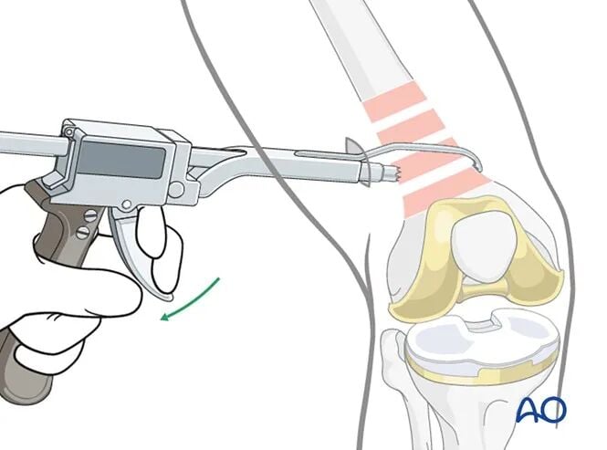 Retrograde Intramedullary Nailing for Periprosthetic Femoral Fractures After TKA: AO Standardized Surgical Strategy – Illustrated Step-by-Step Guide