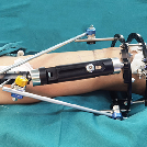 Common complications and treatment methods of external fixation brackets during surgery