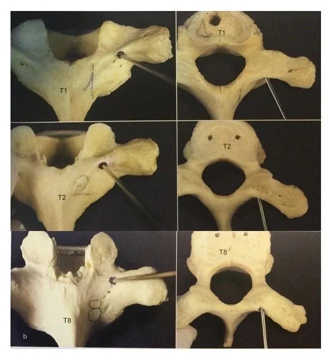 Pedicle Screw Placement Techniques for the Cervical, Thoracic, and Lumbar Spine