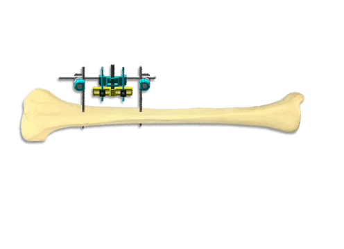 The Design and Functionality of Metal Bone Needle