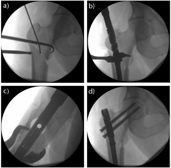 Subtrochanteric Femur Fractures: Anatomy, Classification, and Treatment Options