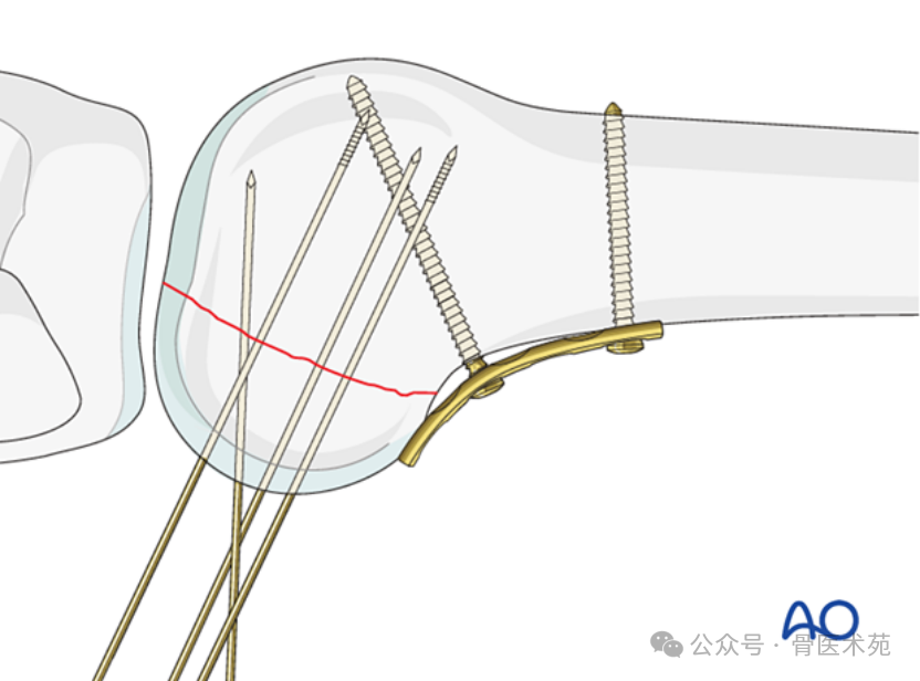 Open Reduction and Internal Fixation of Hoffa Fracture with Plate and Screws