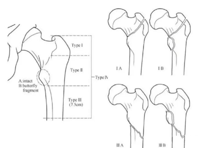 Proximal Femoral Fractures: Classification-Guided Treatment