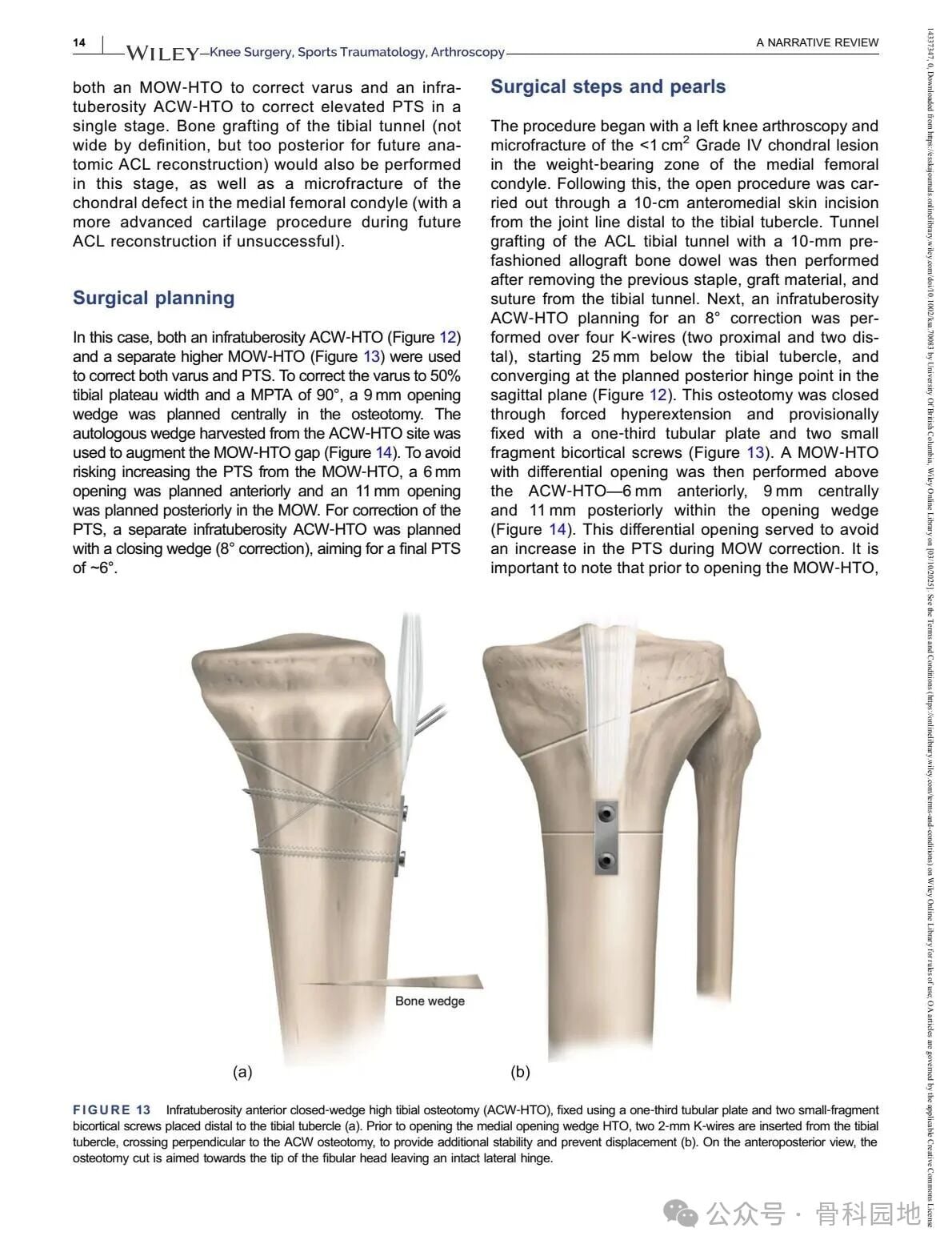 Technical Tips and Tricks for Complex Biplanar High Tibial Osteotomy