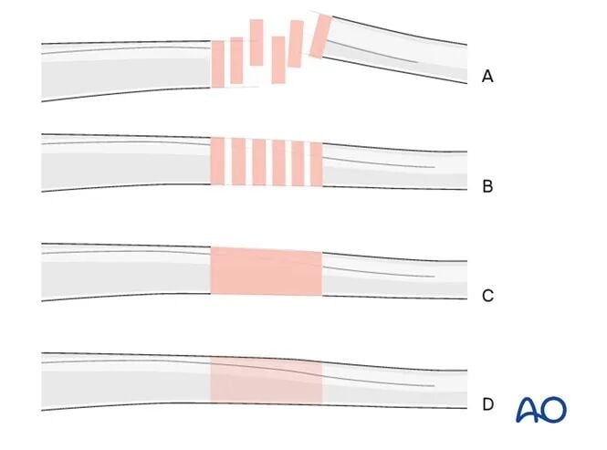 Retrograde Intramedullary Nailing for Periprosthetic Femoral Fractures After TKA: AO Standardized Surgical Strategy – Illustrated Step-by-Step Guide