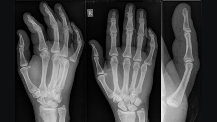 X-ray interpretation (ABCS approach)