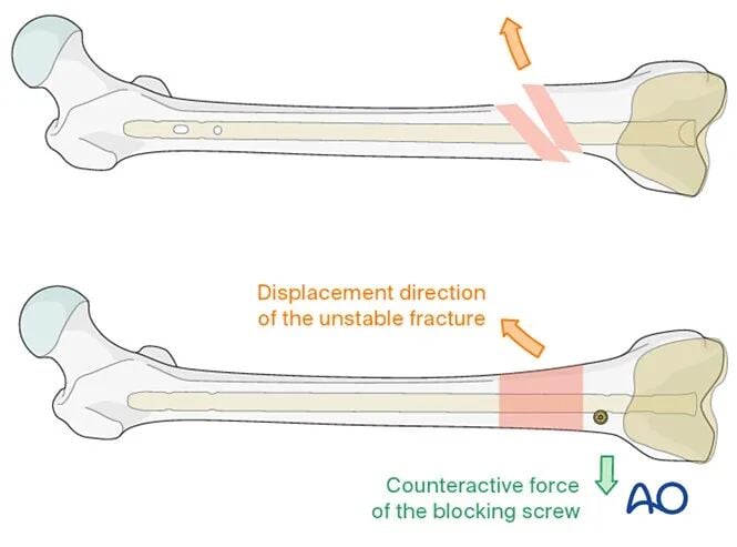 Retrograde Intramedullary Nailing for Periprosthetic Femoral Fractures After TKA: AO Standardized Surgical Strategy – Illustrated Step-by-Step Guide