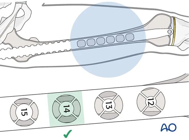 Retrograde Intramedullary Nailing for Periprosthetic Femoral Fractures After TKA: AO Standardized Surgical Strategy – Illustrated Step-by-Step Guide