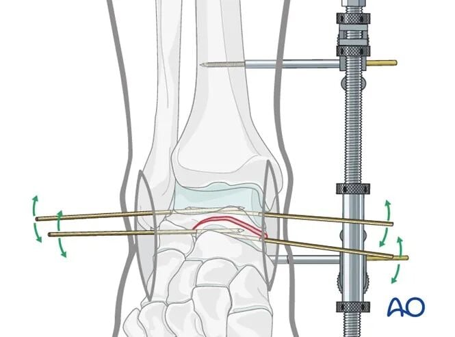 AO Standard Surgery: Screw Fixation for Displaced Talar Neck Fractures