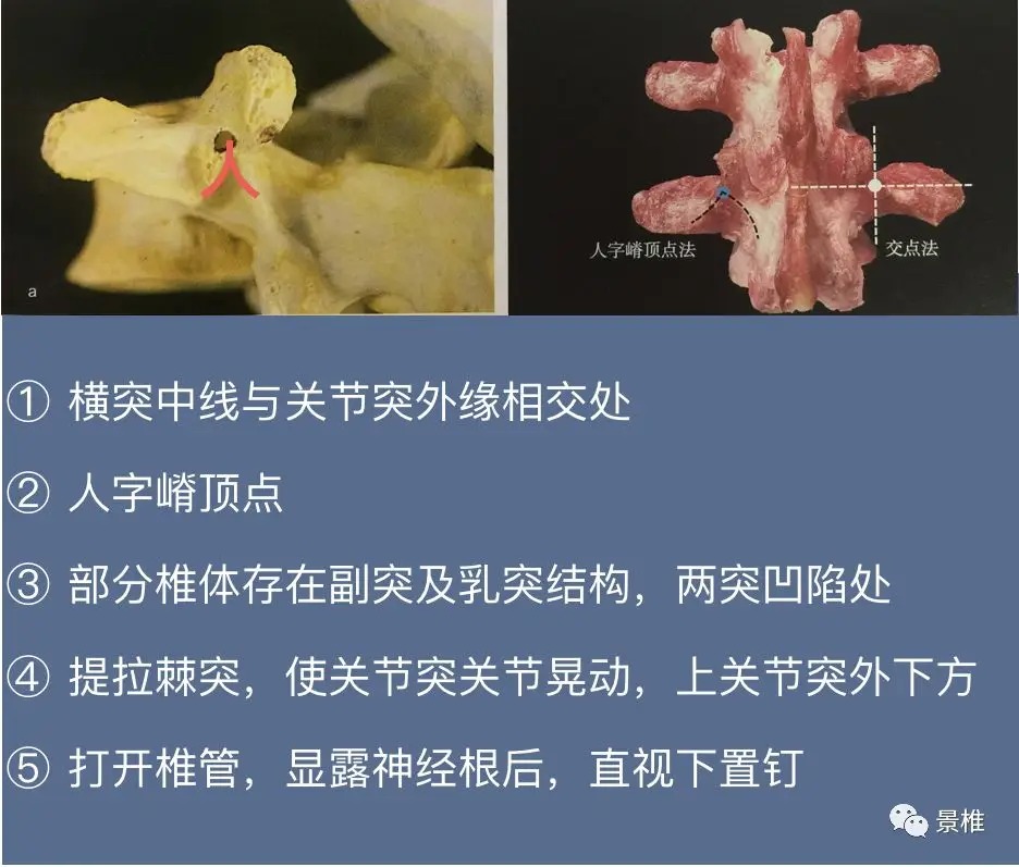 Pedicle Screw Placement Techniques for the Cervical, Thoracic, and Lumbar Spine