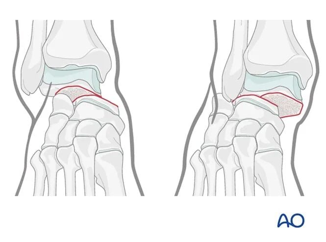 AO Standard Surgery: Screw Fixation for Displaced Talar Neck Fractures