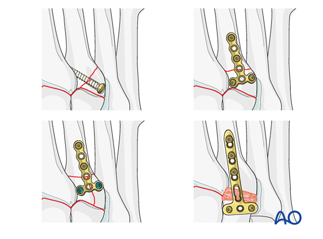 IV. Approach Preparation
