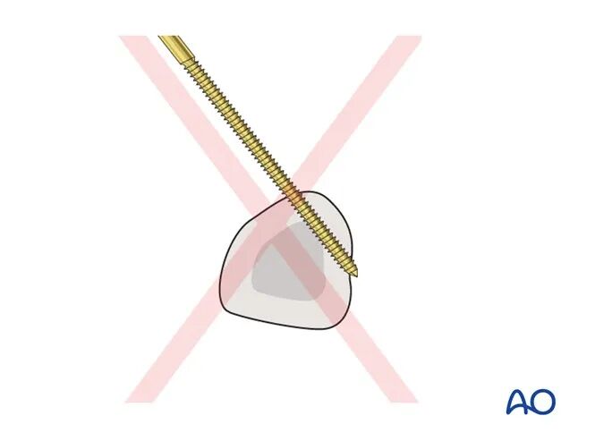 Transarticular External Fixation for Distal Radius Fractures