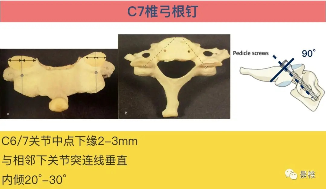 Pedicle Screw Placement Techniques for the Cervical, Thoracic, and Lumbar Spine