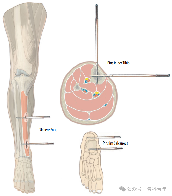 Surgical Steps