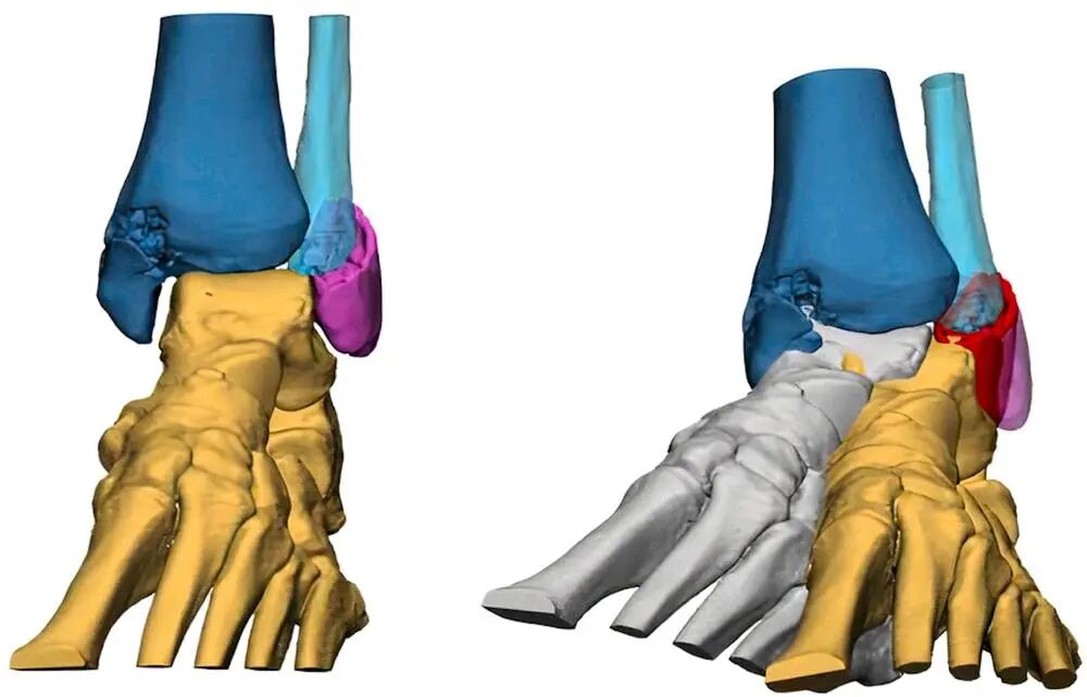 Innovative approach to intramedullary nailing of the fibula: atechnical note