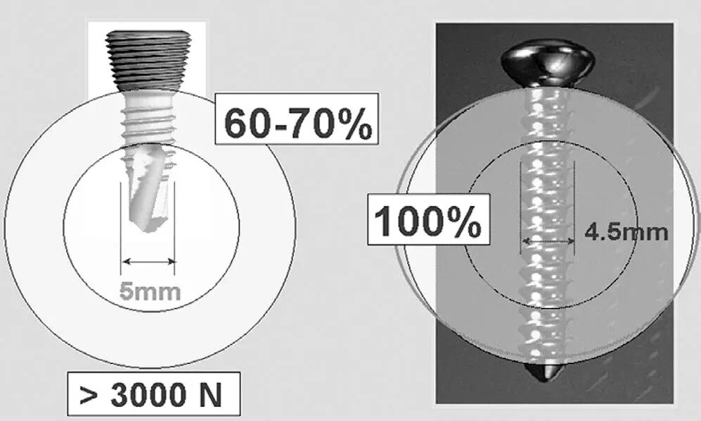 Locking Compression Plate (LCP): Principles and Clinical Applications