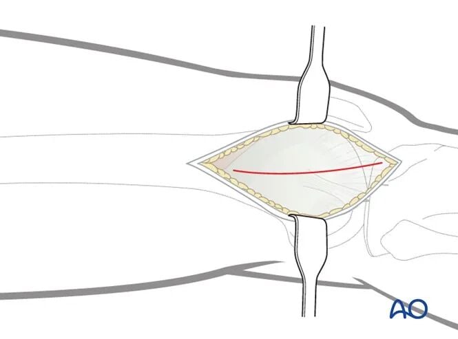 Minimally Invasive Lateral/Anterolateral MIPO Approach to the Distal Femur