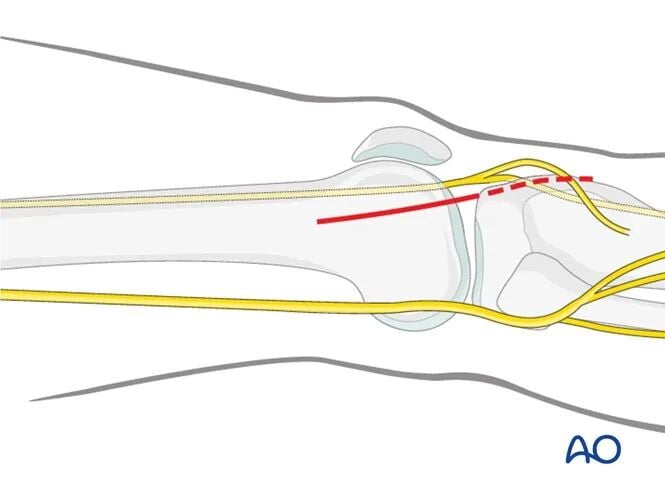Minimally Invasive Lateral/Anterolateral MIPO Approach to the Distal Femur