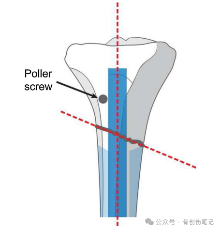 How to Precisely Place Poller (Blocking) Screws?