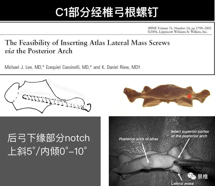 Pedicle Screw Placement Techniques for the Cervical, Thoracic, and Lumbar Spine
