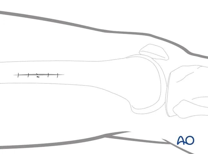 Minimally Invasive Lateral/Anterolateral MIPO Approach to the Distal Femur